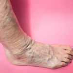 Varicose Vein Treatments Center, New York