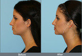 Nose Reshaping Surgery in Mumbai  at Aesthetic Clinic, Andheri (W) Mumbai