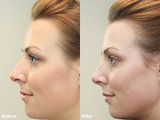 Nose Reshaping Surgery in Mumbai  at Aesthetic Clinic, Andheri (W) Mumbai