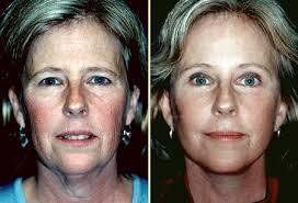  Profile Photos of Facelift Surgery in Mumbai at Aesthetic Clinic 7th Floor,Convention Centre Wing,Kokilaben Dhirubhai Ambani Hospital - Photo 1 of 3