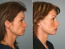  Profile Photos of Facelift Surgery in Mumbai at Aesthetic Clinic 7th Floor,Convention Centre Wing,Kokilaben Dhirubhai Ambani Hospital - Photo 2 of 3