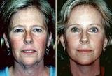 Facelift Surgery in Mumbai at Aesthetic Clinic, Mumbai