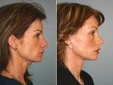 Facelift Surgery in Mumbai at Aesthetic Clinic, Mumbai