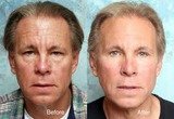 Facelift Surgery in Mumbai at Aesthetic Clinic, Mumbai