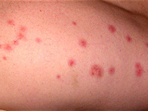 bed bug services in delhi NCR Profile Photos of Professionalâ€™z PMS C â€“ 1155, Sushant Lok â€“ 1 - Photo 21 of 28