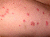 bed bug services in delhi NCR Professionalâ€™z PMS C â€“ 1155, Sushant Lok â€“ 1 