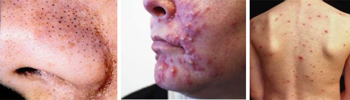  Profile Photos of Acne Treatment in Delhi, India Ambawatta One, H5/5, First Floor, Kalka Das Marg, Mehrauli - Photo 1 of 5