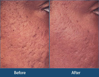  Profile Photos of Acne Treatment in Delhi, India Ambawatta One, H5/5, First Floor, Kalka Das Marg, Mehrauli - Photo 4 of 5