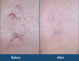 Acne Treatment in Delhi, India, New Delhi