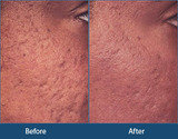 Acne Treatment in Delhi, India, New Delhi