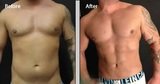 Liposuction Surgery - Aesthetic Clinic, Mumbai