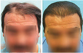  Profile Photos of Hair Transplant A-32, Block A, Gulmohar Park, Near Siri fort Auditorium, New Delhi -110049 - Photo 1 of 2
