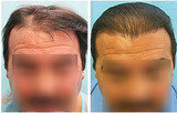 Hair Transplant, Near Siri fort Auditorium,