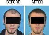 Hair Transplant, Near Siri fort Auditorium,