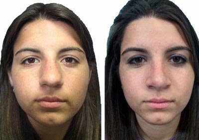  Profile Photos of Nose Reshaping Surgery in Mumbai â€“ Aesthetic Clinic 7th Floor,Convention Centre Wing,Kokilaben Dhirubhai Ambani Hospital - Photo 4 of 4