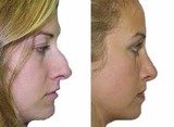 Nose Reshaping Surgery in Mumbai â€“ Aesthetic Clinic, Mumbai