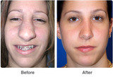Nose Reshaping Surgery in Mumbai â€“ Aesthetic Clinic, Mumbai
