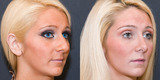 Nose Reshaping Surgery in Mumbai â€“ Aesthetic Clinic, Mumbai