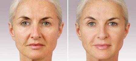 Wagre Fraxel Laser Clinic Melbourne Profile Photos of Wagre Fraxel Laser Clinic Melbourne 100 Collins Street - Photo 4 of 8