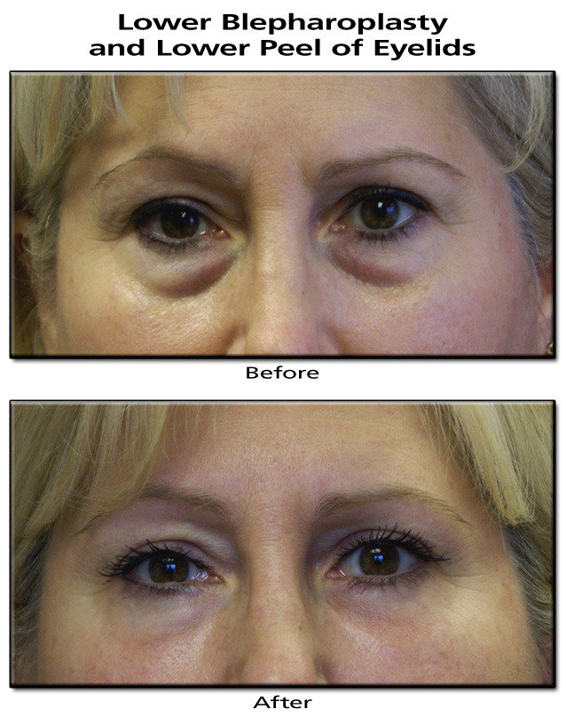  Profile Photos of Eyelid Surgery in Mumbai â€“ Aesthetic Clinic 7th Floor,Convention Centre Wing,Kokilaben Dhirubhai Ambani Hospital - Photo 1 of 3