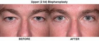  Profile Photos of Eyelid Surgery in Mumbai â€“ Aesthetic Clinic 7th Floor,Convention Centre Wing,Kokilaben Dhirubhai Ambani Hospital - Photo 2 of 3