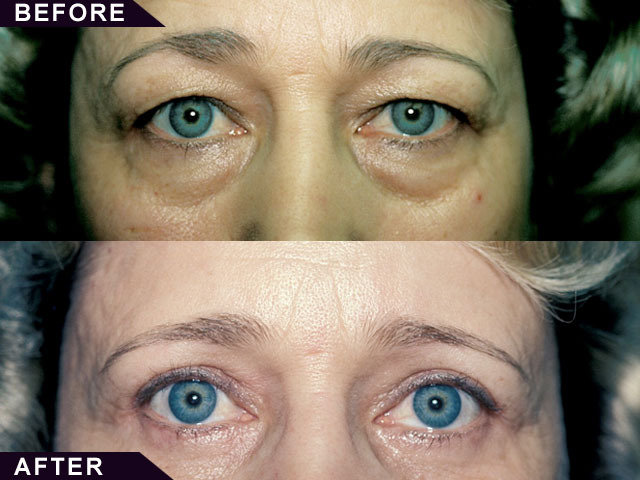  Profile Photos of Eyelid Surgery in Mumbai â€“ Aesthetic Clinic 7th Floor,Convention Centre Wing,Kokilaben Dhirubhai Ambani Hospital - Photo 3 of 3
