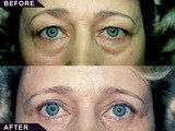 Eyelid Surgery in Mumbai â€“ Aesthetic Clinic, Mumbai
