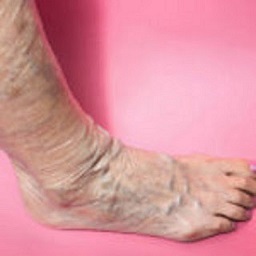  Profile Photos of Varicose Vein Treatments Center 983 Park Avenue, Ste 1D12 - Photo 1 of 5