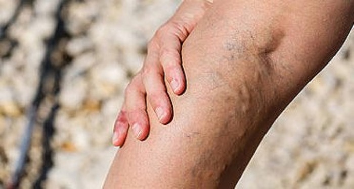  Profile Photos of Varicose Vein Treatments Center 983 Park Avenue, Ste 1D12 - Photo 5 of 5