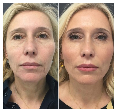  Profile Photos of Microneedling For Stretch Marks 12 E Palisade Avenue, Suite C-8H - Photo 7 of 9