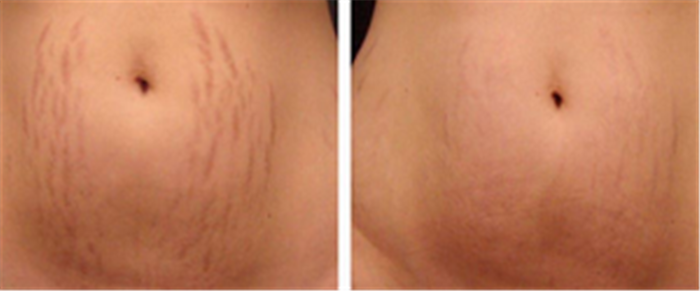  Profile Photos of Microneedling For Stretch Marks 12 E Palisade Avenue, Suite C-8H - Photo 8 of 9