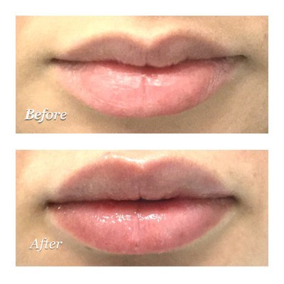  Profile Photos of Microneedling For Stretch Marks 12 E Palisade Avenue, Suite C-8H - Photo 9 of 9