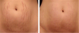 Microneedling For Stretch Marks, Englewood