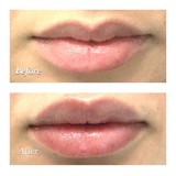 Microneedling For Stretch Marks, Englewood
