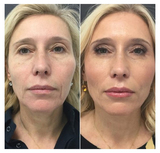 Best Lip Filler & Injections, Englewood