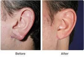  Profile Photos of Ear Reshaping Surgery at Aesthetic Clinic 7th Floor,Convention Centre Wing,Kokilaben Dhirubhai Ambani Hospital - Photo 3 of 4