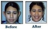 Ear Reshaping Surgery at Aesthetic Clinic, Mumbai