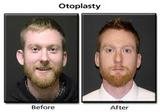 Ear Reshaping Surgery at Aesthetic Clinic, Mumbai