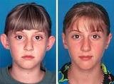 Ear Reshaping Surgery at Aesthetic Clinic, Mumbai