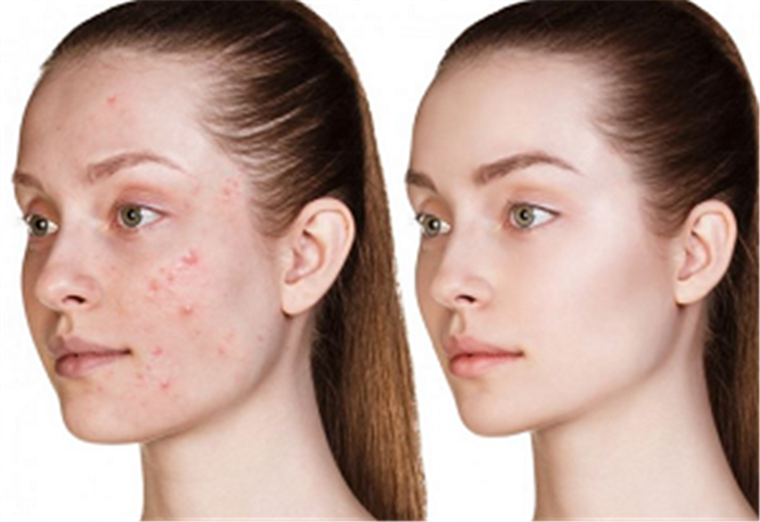  Profile Photos of Whiteheads & Blackheads Removal 12 E Palisade Avenue, Suite C-11K - Photo 12 of 12