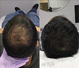  Whiteheads & Blackheads Removal 12 E Palisade Avenue, Suite C-11K 