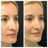  Whiteheads & Blackheads Removal 12 E Palisade Avenue, Suite C-11K 