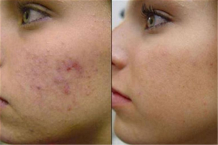  Profile Photos of Teen Acne Treatment And Facial 12 E Palisade Avenue, Suite C-14N - Photo 7 of 11