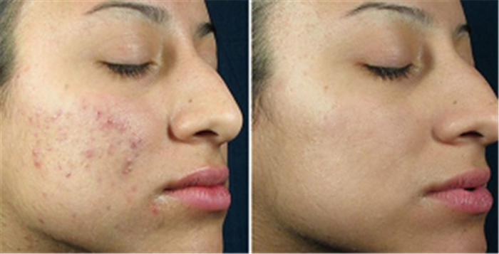  Profile Photos of Teen Acne Treatment And Facial 12 E Palisade Avenue, Suite C-14N - Photo 8 of 11