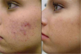  Teen Acne Treatment And Facial 12 E Palisade Avenue, Suite C-14N 