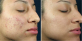  Teen Acne Treatment And Facial 12 E Palisade Avenue, Suite C-14N 