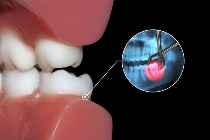  New Album of Tooth Extractions Pickering 1300 Kingston Road Unit #3 - Photo 9 of 15