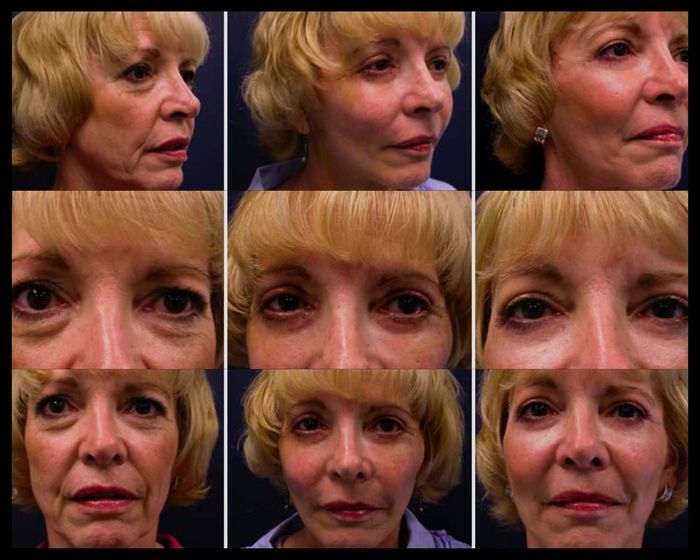 Facelift Chicago Profile Photos of Best Clinic for Liquid Facelift Chicago 7157 Howard St - Photo 1 of 1