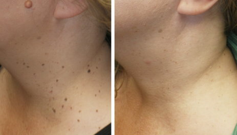  New Album of Mole Removal Los Angeles 1950 Sawtelle Blvd, Suite 138-M - Photo 4 of 5