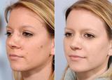  Mole Removal Los Angeles 1950 Sawtelle Blvd, Suite 138-M 
